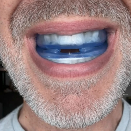 Trevalisse Anti-Snoring Mouthpiece (Buy 1 Get 1 Free)